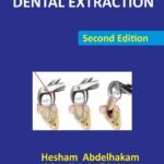 Dental Extraction Second Edition